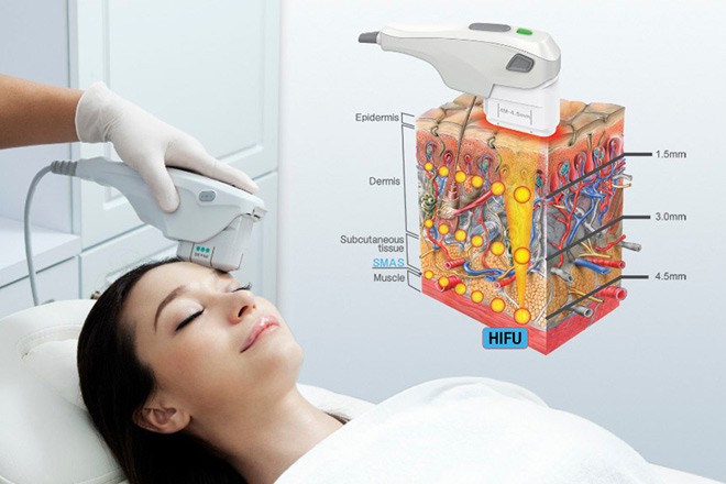 may-nang-co-xoa-nhan-hifu-dai-loan